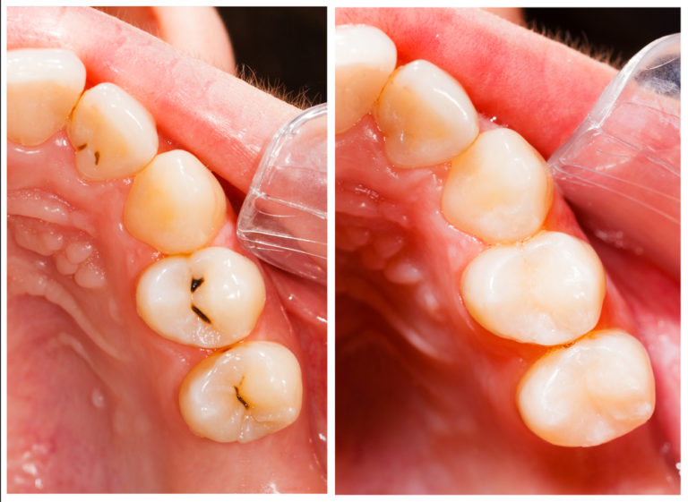 Dental Implant Kitchener