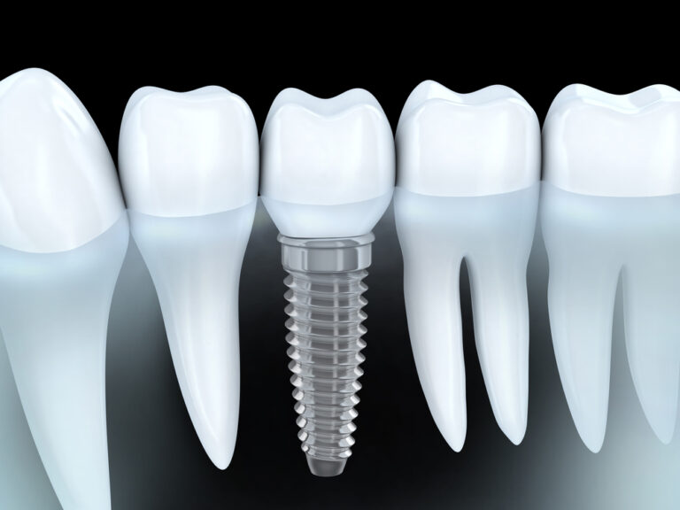 Dental Implants Kitchener-Forest Hill Family Dental