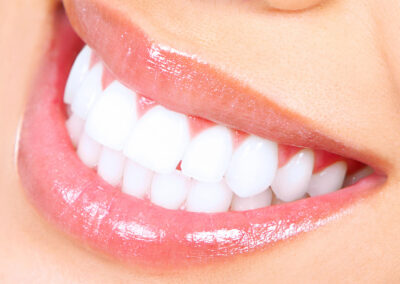 Teeth-Whitening